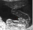 Ultrasound scan of male fetus - Sex selection has attracted great interest and contraversy.