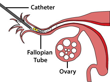 The gamete intra-fallopian transfer (GIFT) procedure.