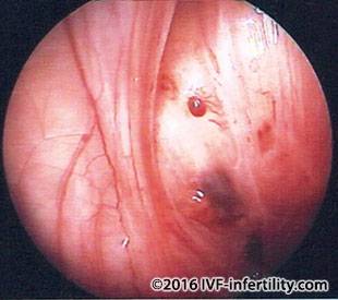  laparoscopy showing mild endometriosis.
