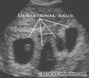 Ultrasound scan showing multiple pregnancy.