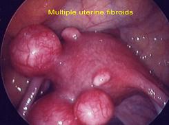 Two Horned Uterus