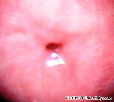 normal cervix 