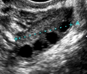 Antral follicles as seen by vaginal ultrasound scan.