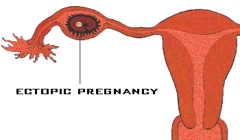 Ectopic pregnancy in the Fallopian tube.