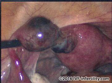  ectopic pregnancy isthmus.