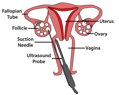 Vaginal ultrsound egg collection.