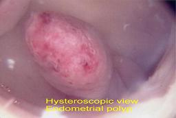 Hysteroscopic view of an endometrial polyp.
