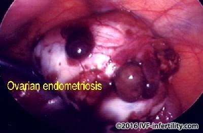 Endometriosis seen through endoscope.