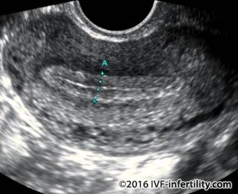 Multiple uterine fibroids