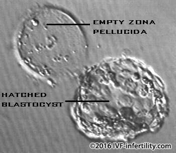 A hatched blastocyst seen through a microscope.