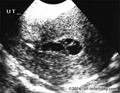 Vaginal ultrasound scan showing intrauterine adhesions.