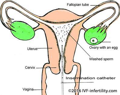 Intrauterine insemination procedure.