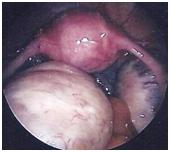 Ovarian drilling.