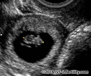 Vaginal ultrasound scan of a live ectopic pregnancy.