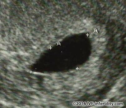Ultrasound scan