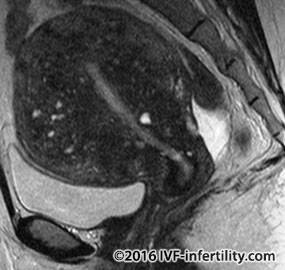 MRI AdenomyosisÃ�ï¿½Ã�Â¯Ã�ï¿½Ã�Â¿Ã�ï¿½Ã�Â½ width=