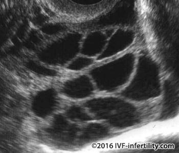 Ultrasound scan of severe ovarian hyperstimulation syndrome (OHSS).