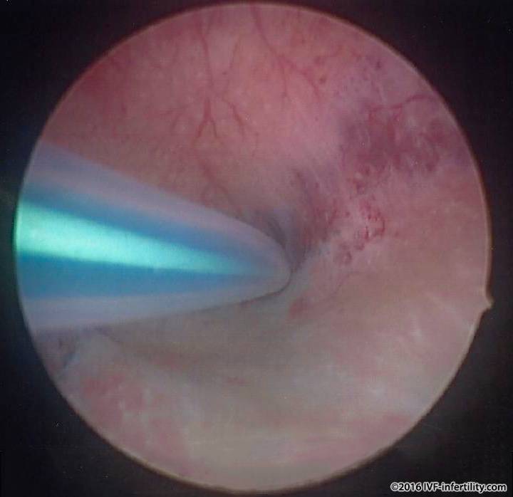 tubal cannulation