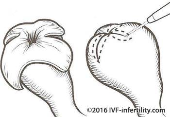 tubal surgery-salpingostomy.