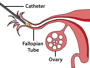 The zygote intra-fallopian transfer (ZIFT) procedure.